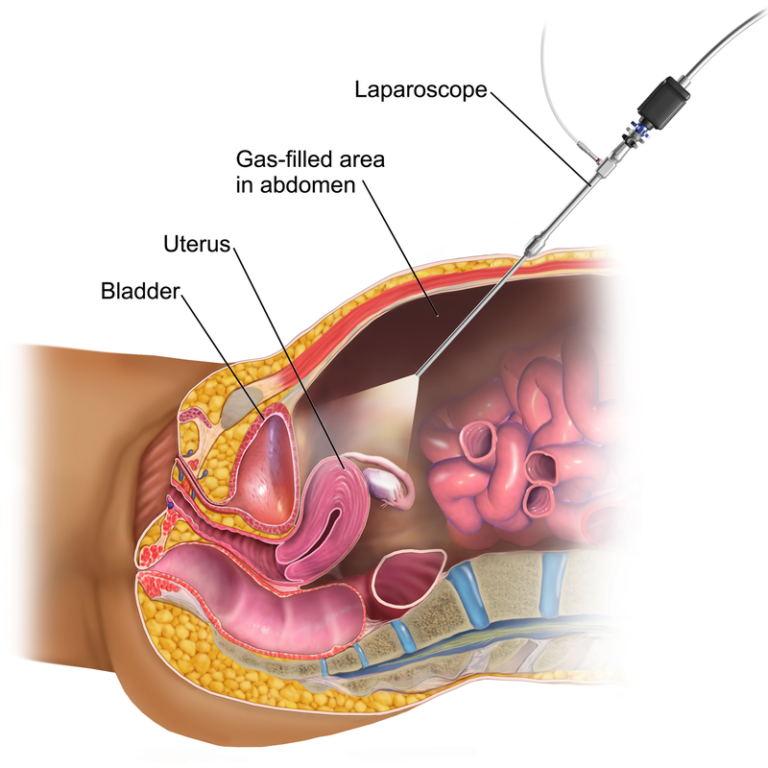 Advanced Laparoscopic Surgery in India
